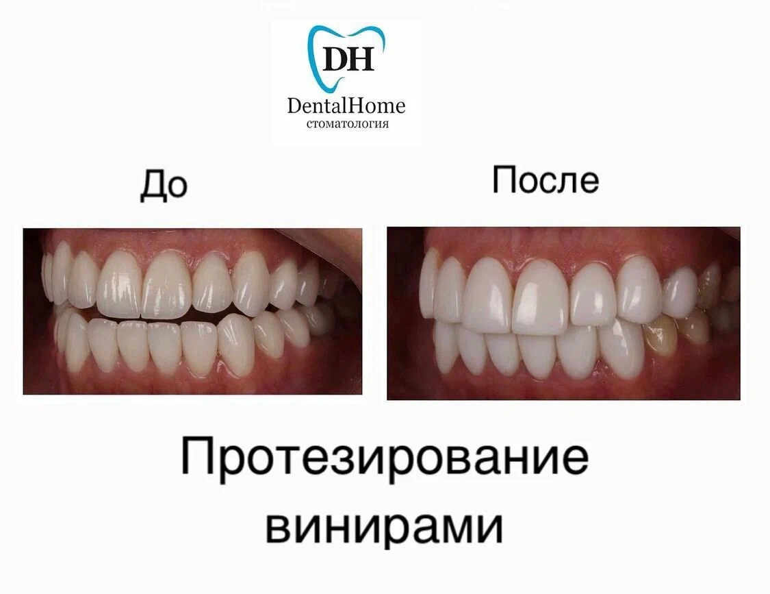 Протезирование винирами
