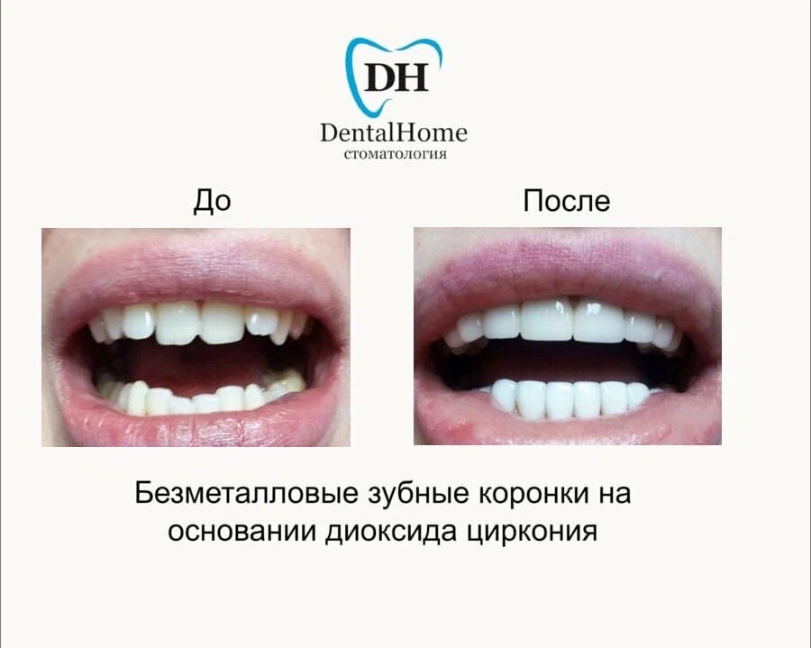 Безметалловые коронки на основе диоксида циркония