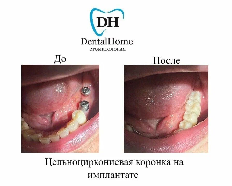 Цельноциркониевая коронка на имплантате